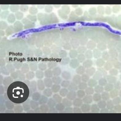 peripheral blood smear acantho