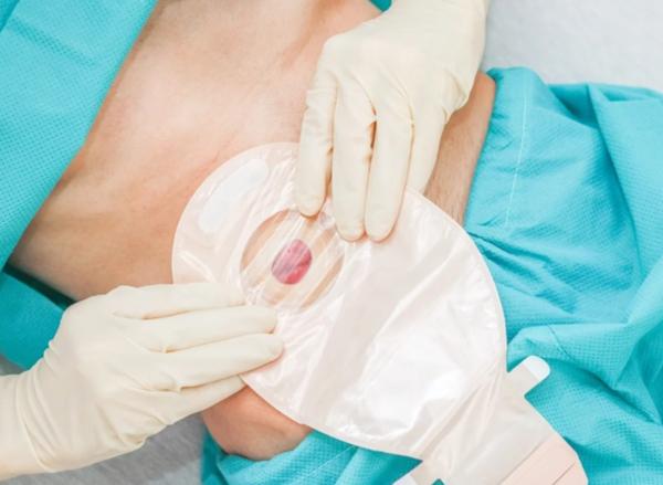 stoma care service at home ahm