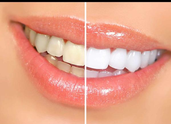 personalized teeth whitening t