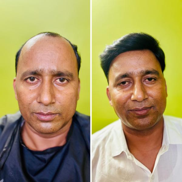 No pain and no operation in this method.