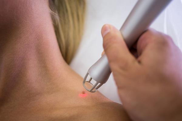 Dealing with stubborn skin war