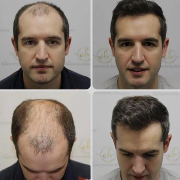 Singh Skin Cure Provides Non-Surgical ha