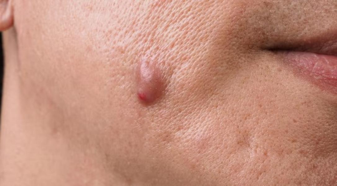 lump excision surgical procedu