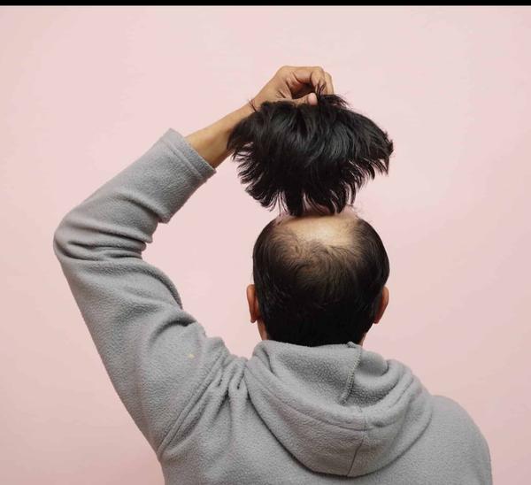 Singh Skin Cure Noida is the best hair w