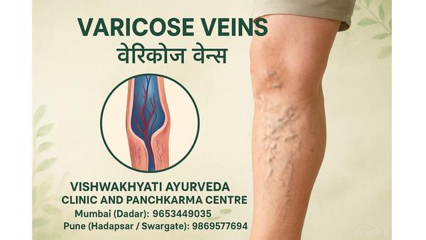Varicose Veins – Don’t Ignore 