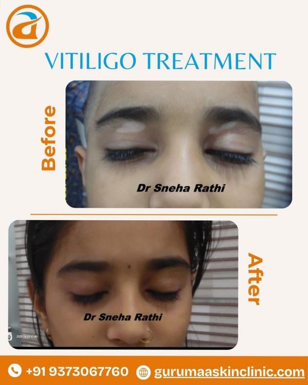 Vitiligo specialist, skin consultant, ayurvedic Vi
