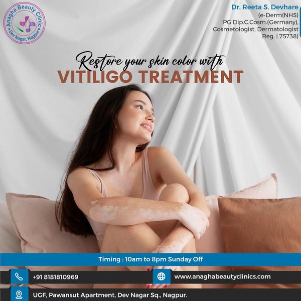 Vitiligo treatment aims to restore skin 