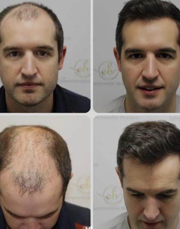 Singh skin cure offer wigs for fashion, 