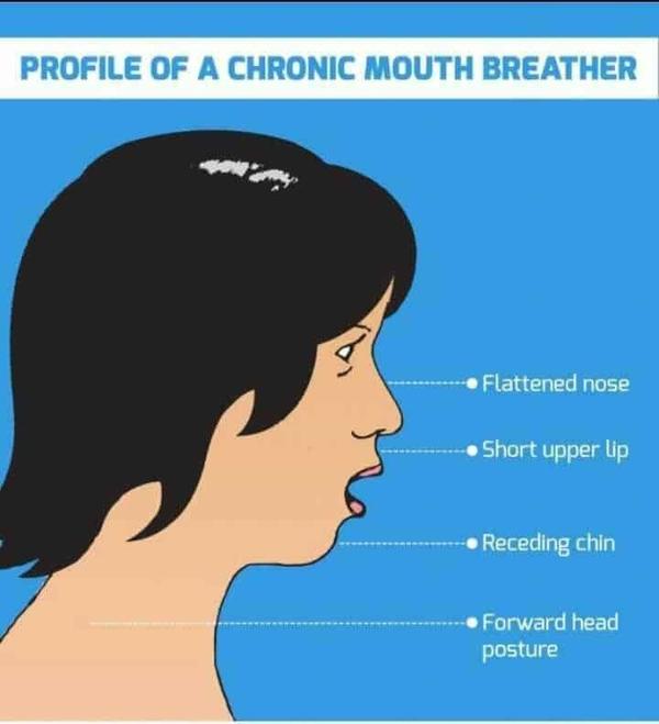 Mouth Breathing Treatment in J