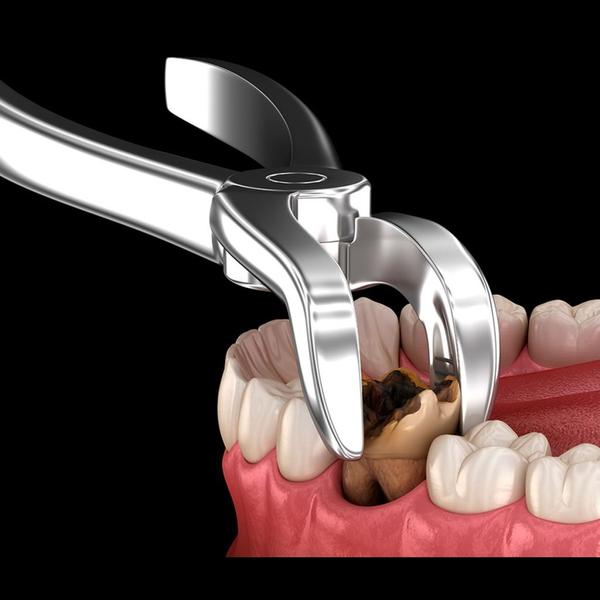 safe and gentle tooth extracti