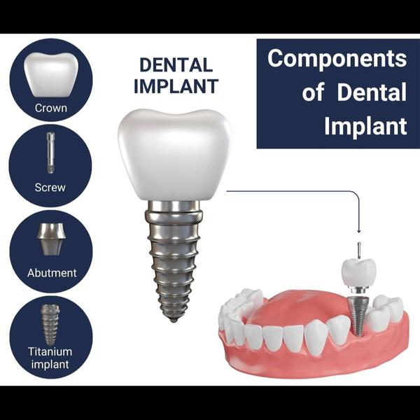 dental implant specialists man