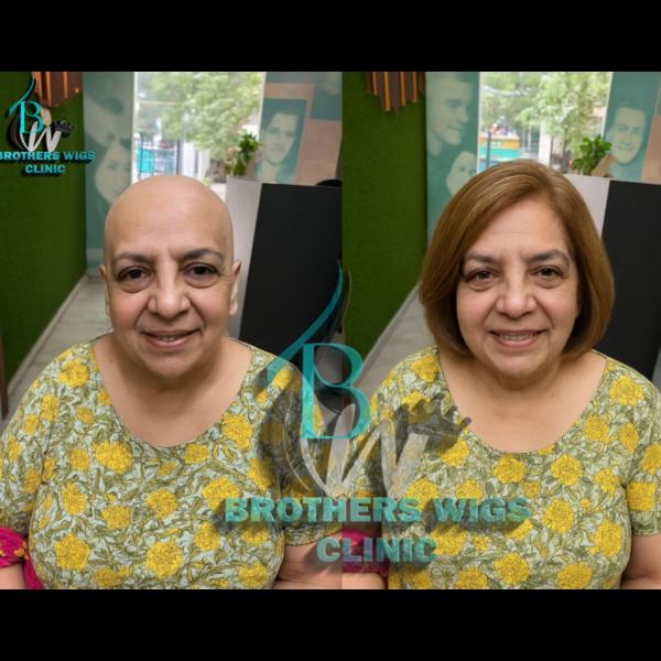 front lace hair patch vikaspur