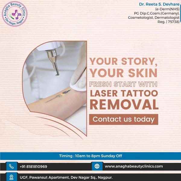 ☄️☄️ Laser Tattoo Removal ☄️☄️ Laser tat