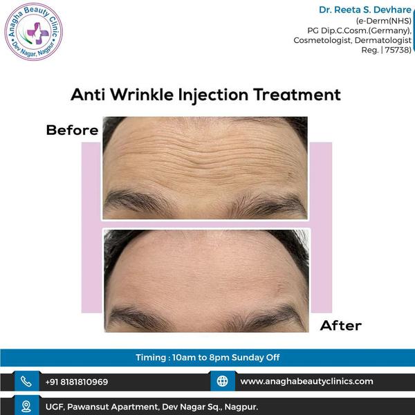 🔍 Anti-wrinkle injection 🔎 Anti -wrink