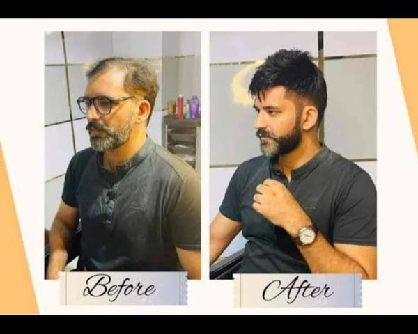 american hairline patch delhi