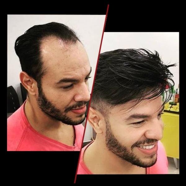 front less skin base hair patc