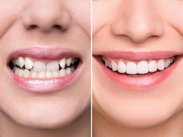 smile makeover services durgap