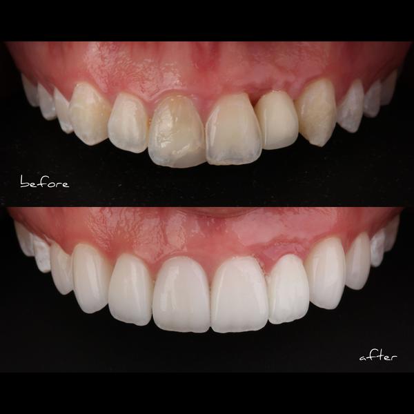 bridal smile makeover in mansa