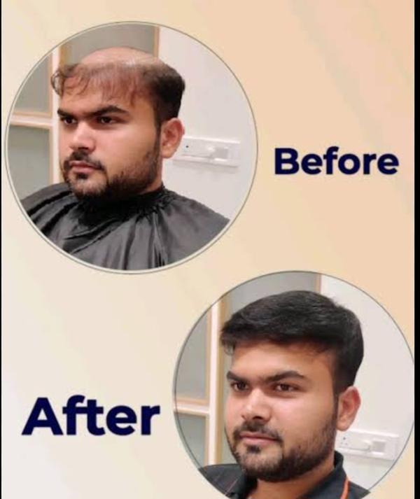 non surgical hair replacement 