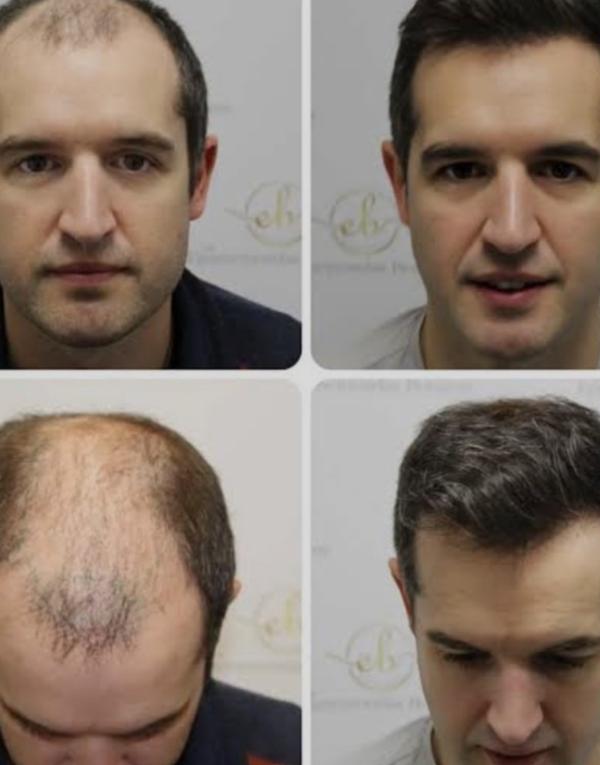 They also offer non-surgical hair replac