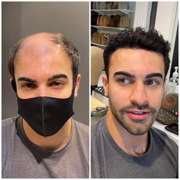 Non-surgical: It is a non-inva