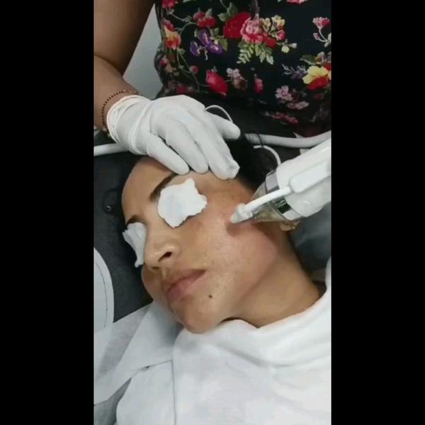 MNRF is one of the recent cosmetic proce