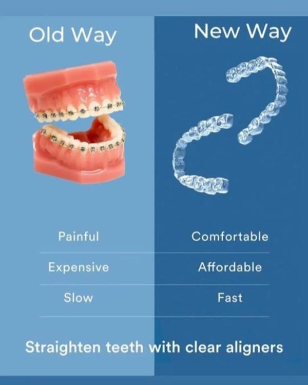 Clear Aligners: A Confide