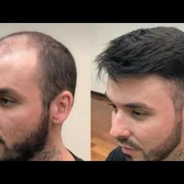 Hair Patch vs. Other Hair Loss