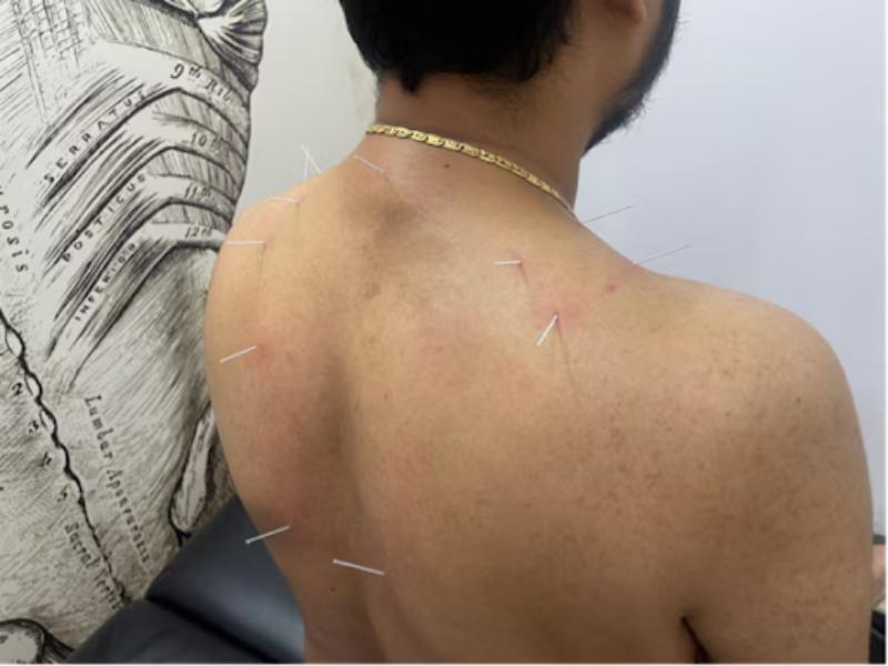 hijama therapy in delhi