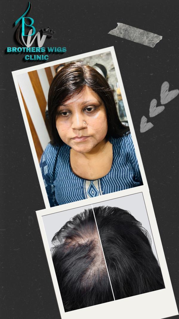 wigs for cancer patients in as