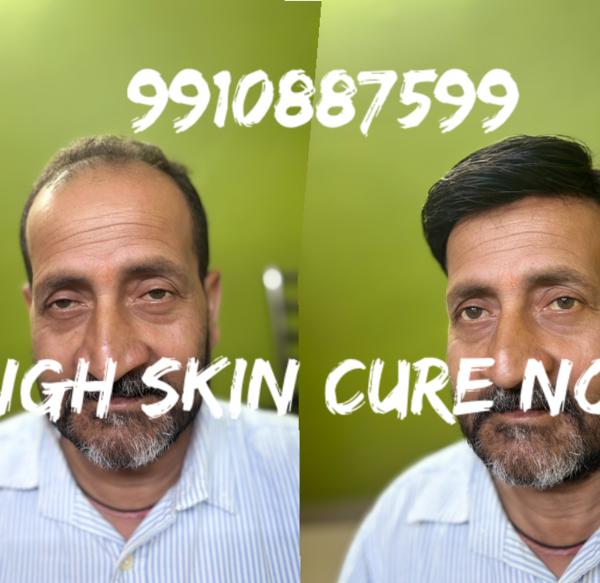 Hair Clipping System is a temporary meth