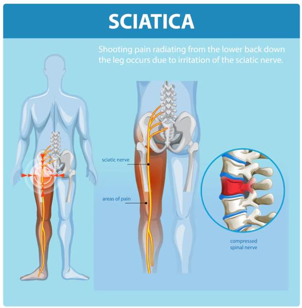 needling therapy for pain mana
