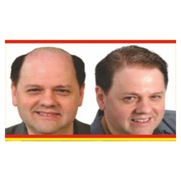 Natural Hair Patches Center In Nagpur - 