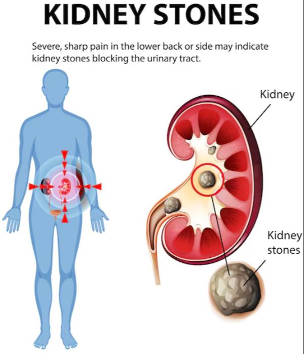 urethral stricture diagnosis m