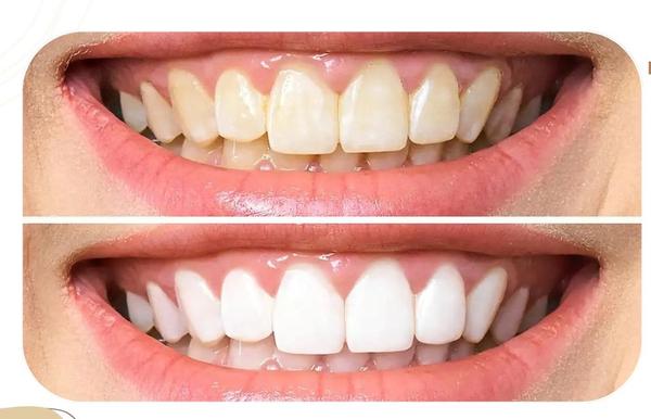 Looking for the best teeth whi