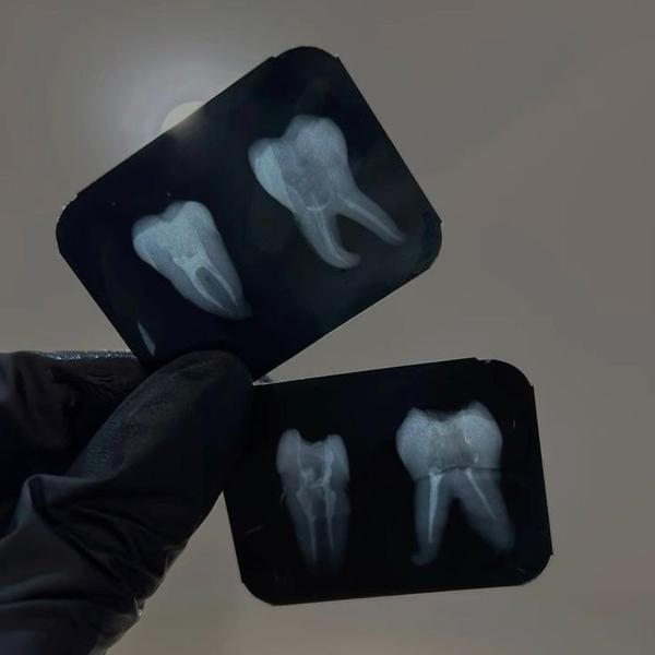 proximal humerus fracture diag