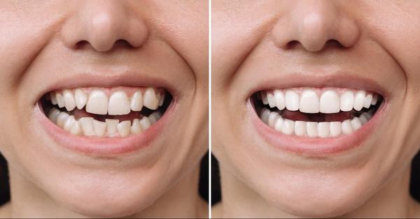 Best Dental Veneers in Mansaro
