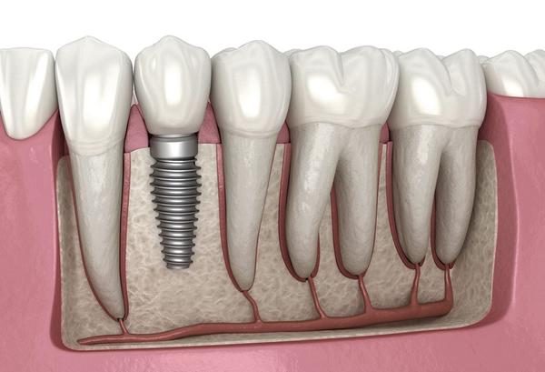 best dental implant clinic in 