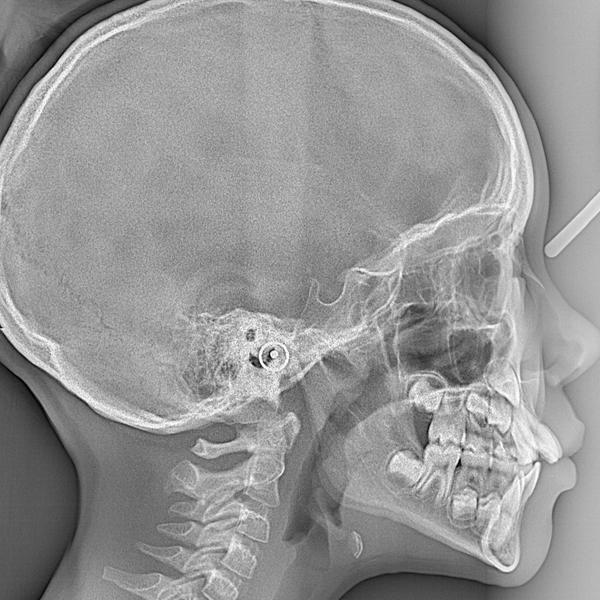 follicular study in rohini