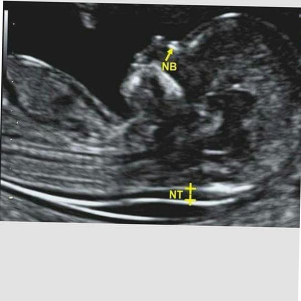 nuchal translucency fluid