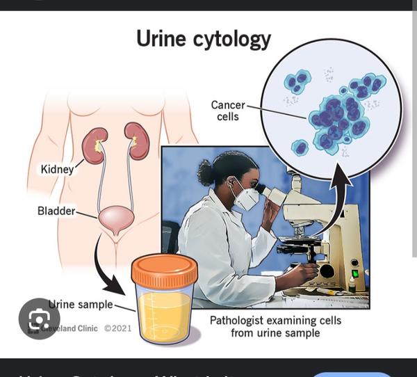 detecting bladder cancer cells