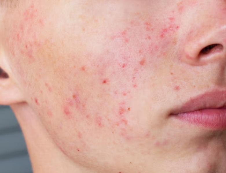 Acne scars can leave a lasting