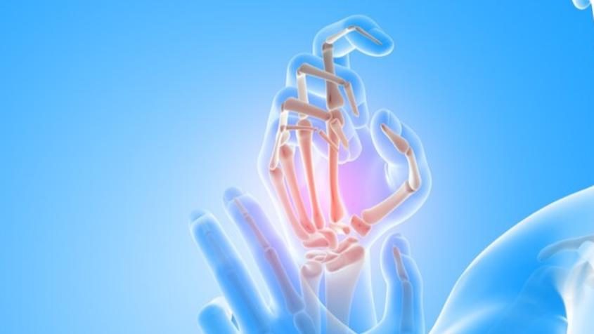 Arthritis is a condition that affects mi