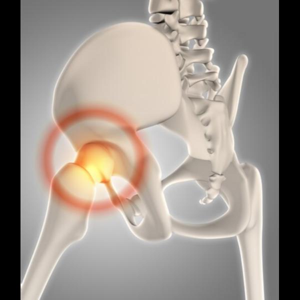 Avascular necrosis (AVN) occurs when blo