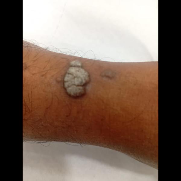 wart removal treatment trichy