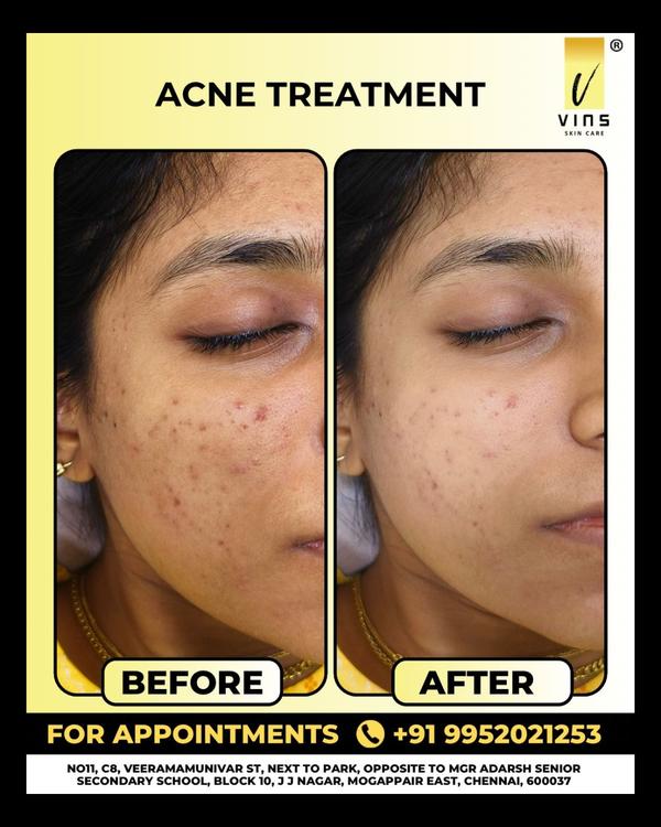 ✨ Clear skin, clear confidence! ✨
At @vi