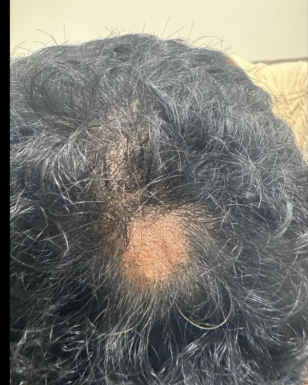 alopecia areata specialist