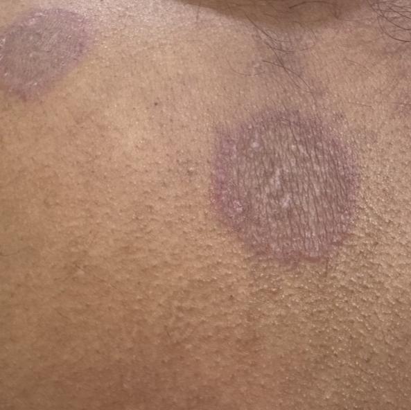 fungal infection doctor in tri