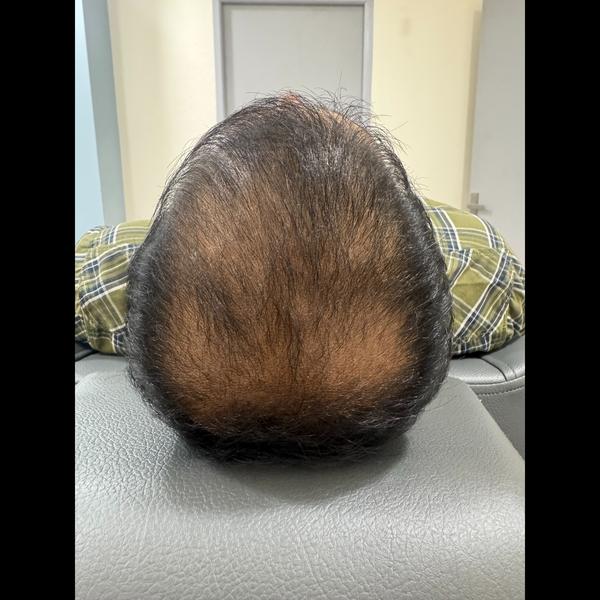 scalp baldness treatment in tr