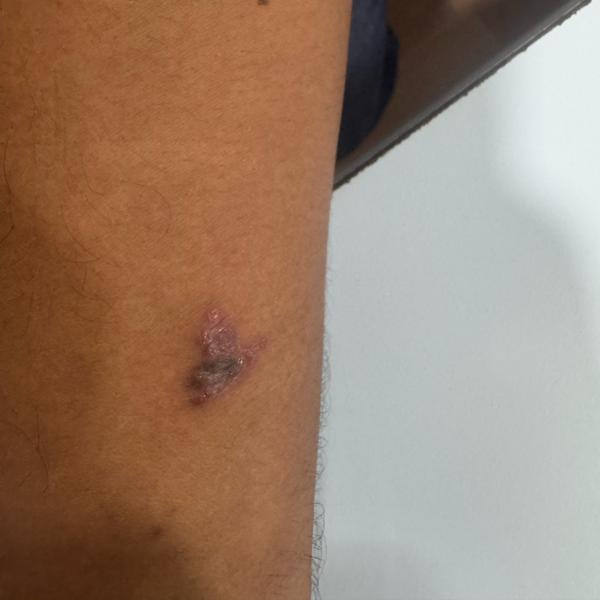 eczema dermatologist trichy